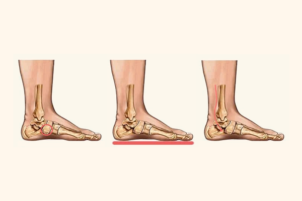 Flat feet shoes store clearance